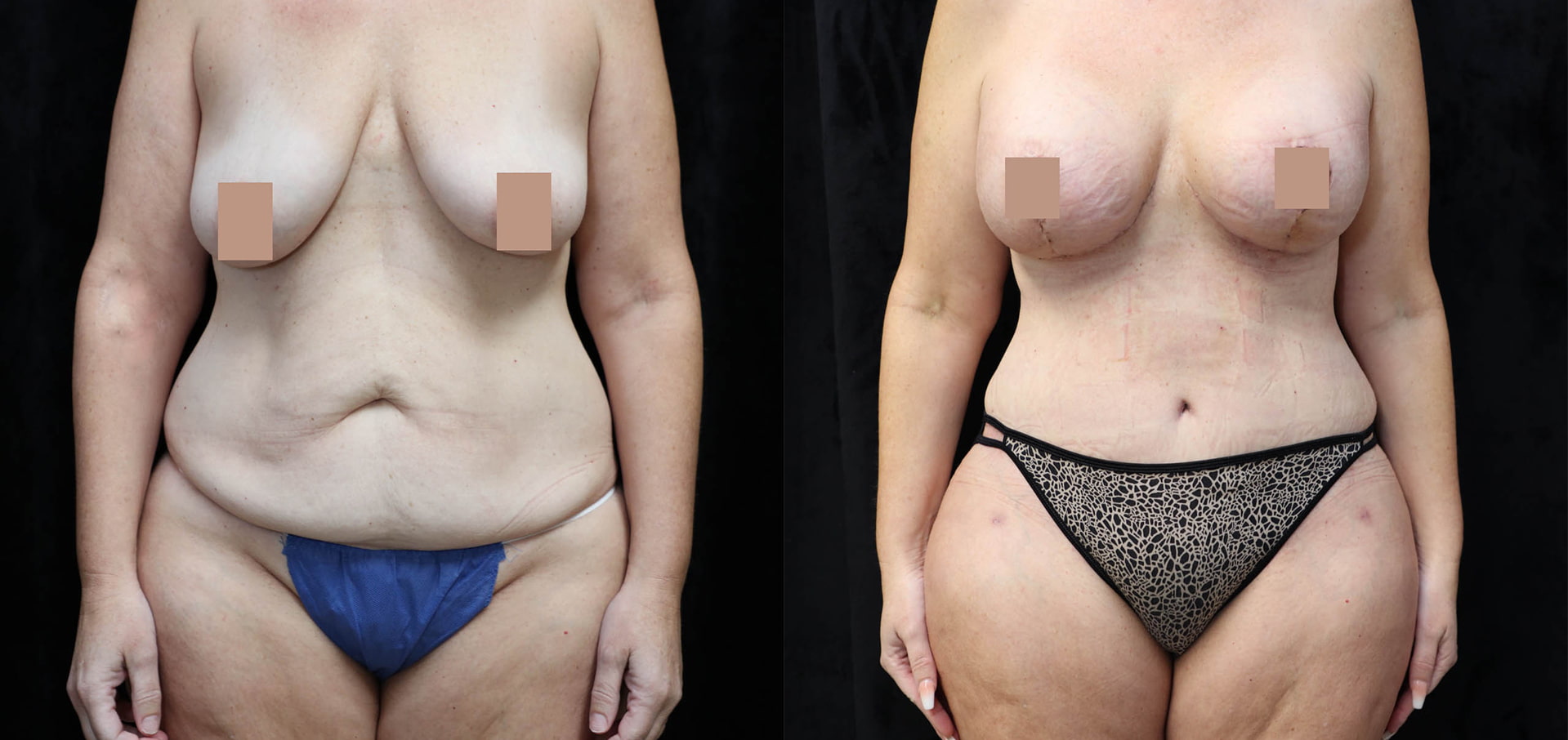Mommy Makeover Before & After Photos