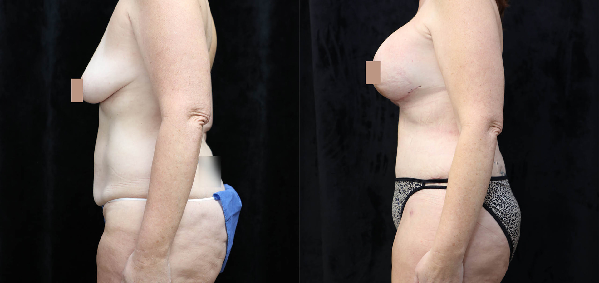 Mommy Makeover Before & After Photos