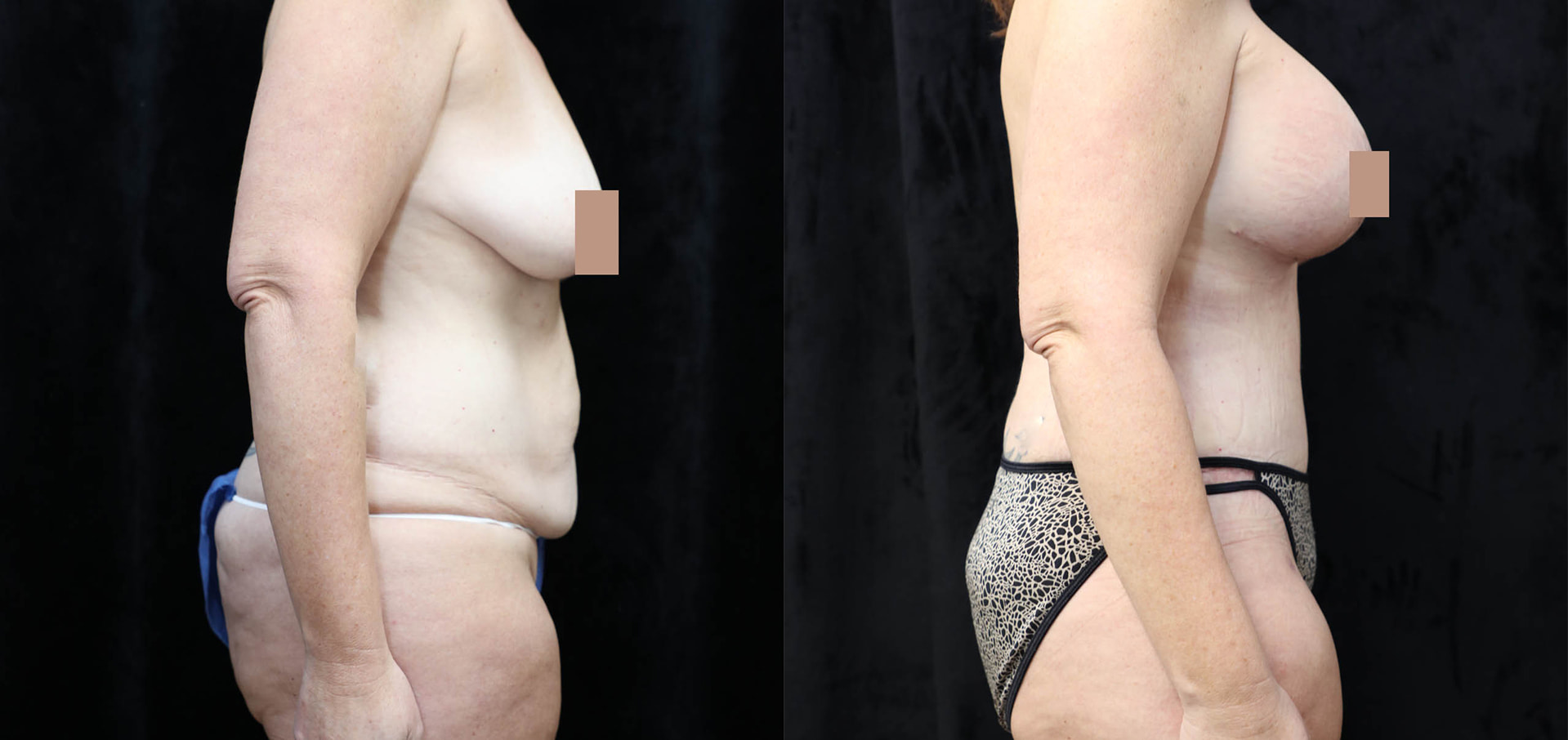Mommy Makeover Before & After Photos