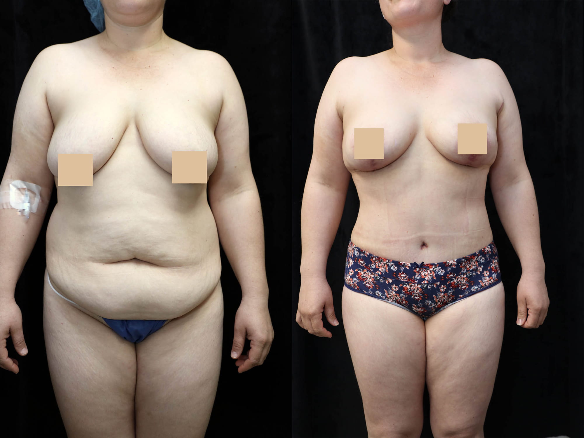 Mommy Makeover Before & After Photos