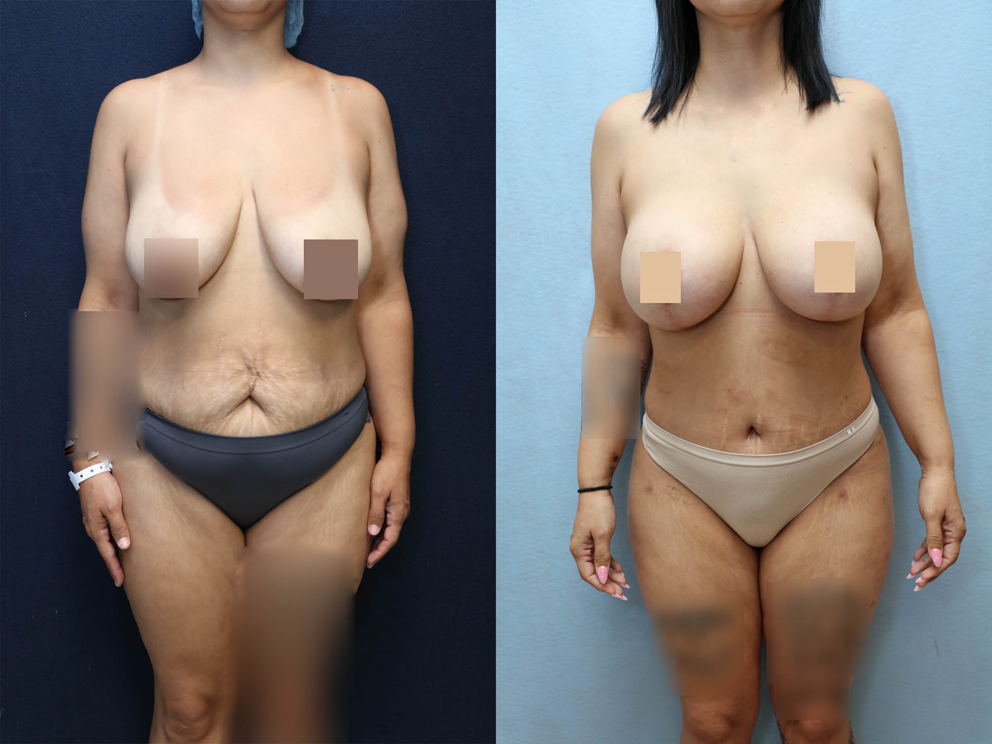 Mommy Makeover Before & After Photos