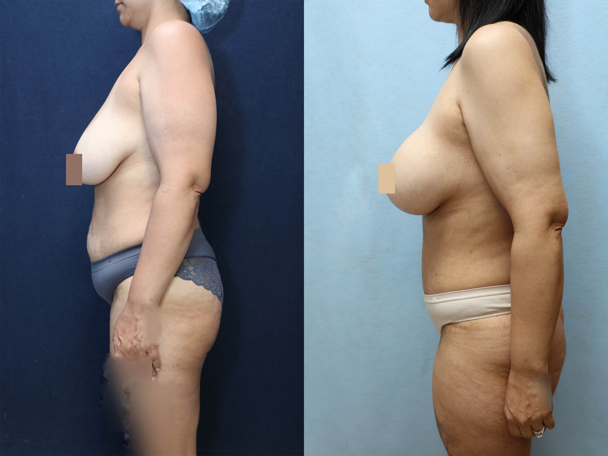 Mommy Makeover Before & After Photos