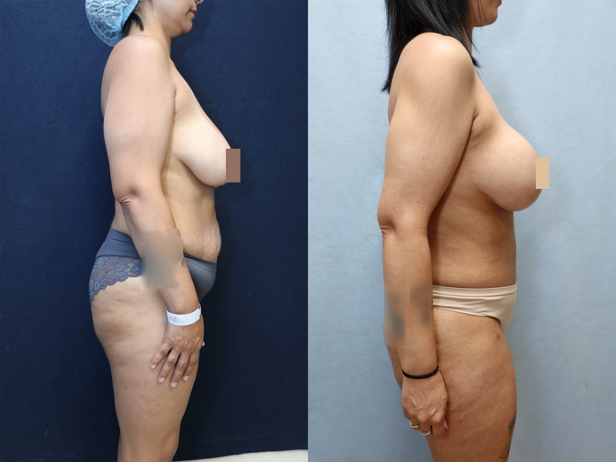 Mommy Makeover Before & After Photos