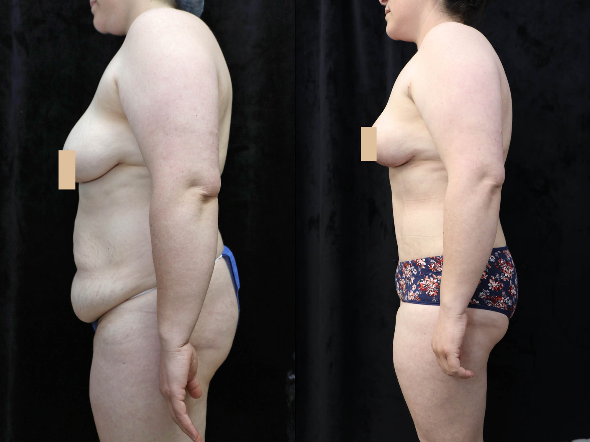Mommy Makeover Before & After Photos