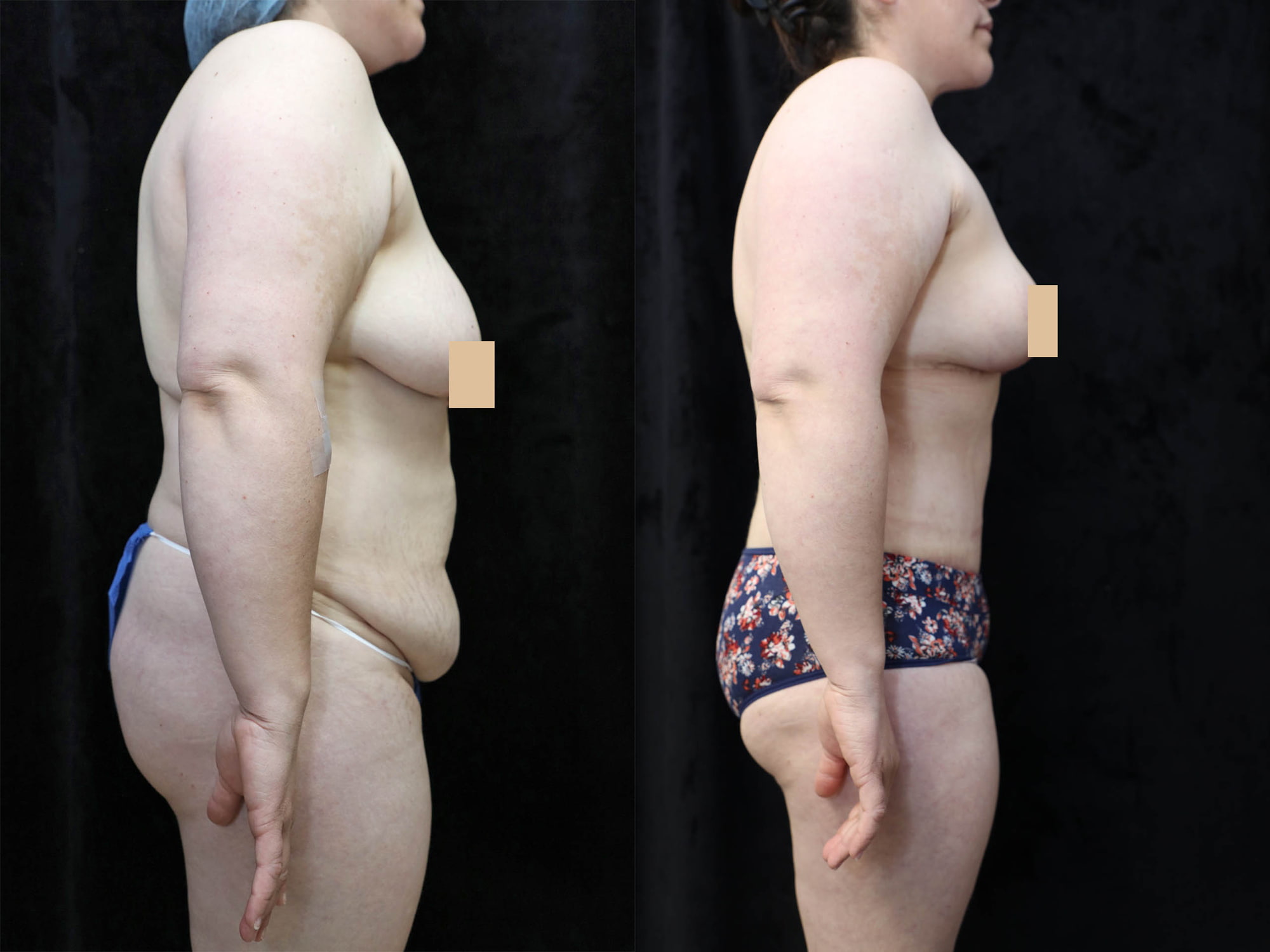 Mommy Makeover Before & After Photos