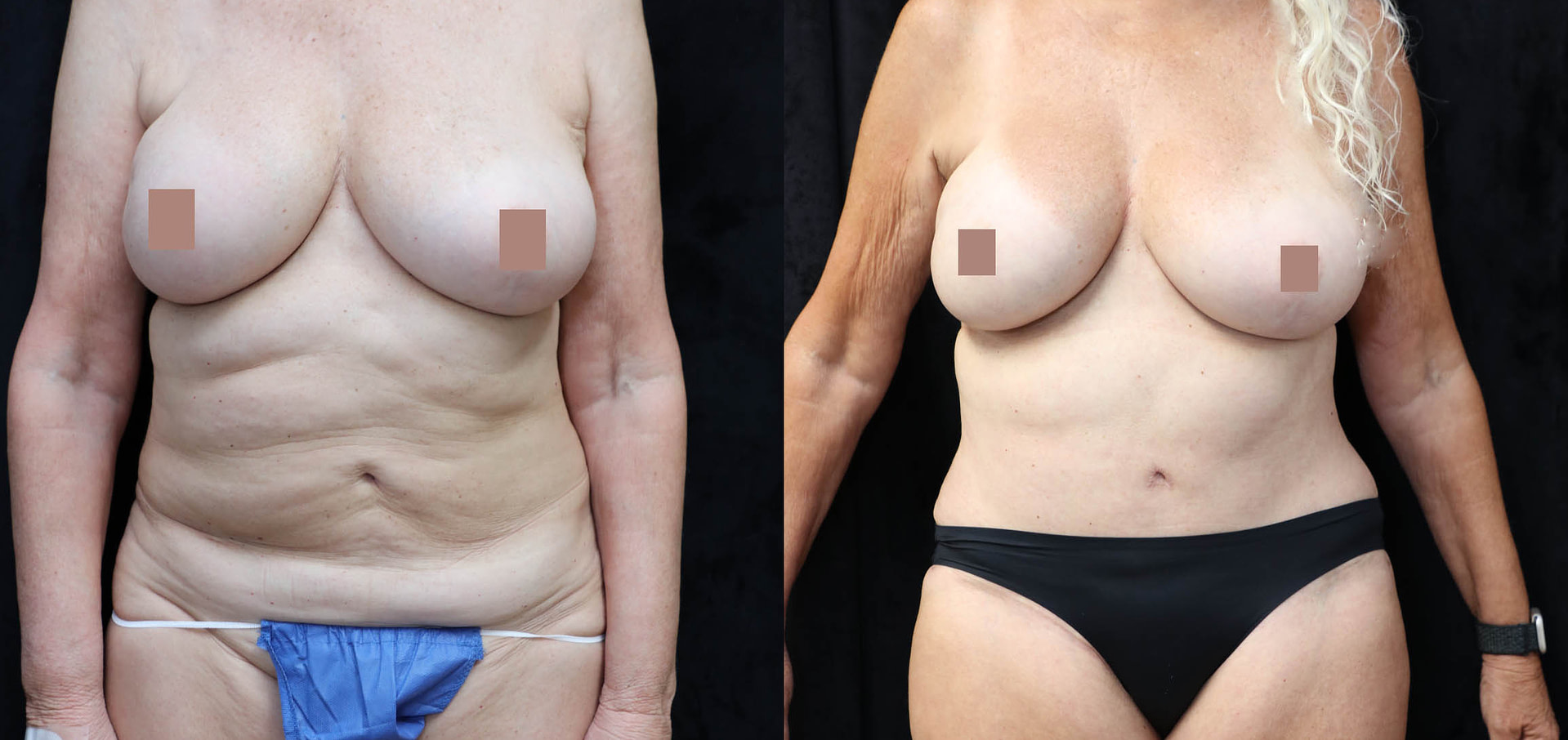 Mommy Makeover Before & After Photos