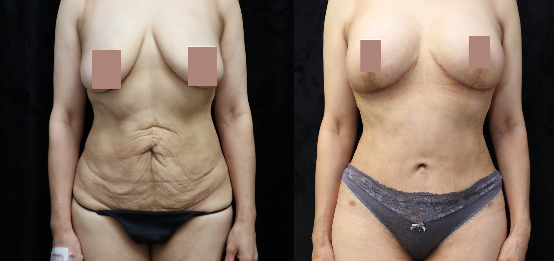 Mommy Makeover Before & After Photos