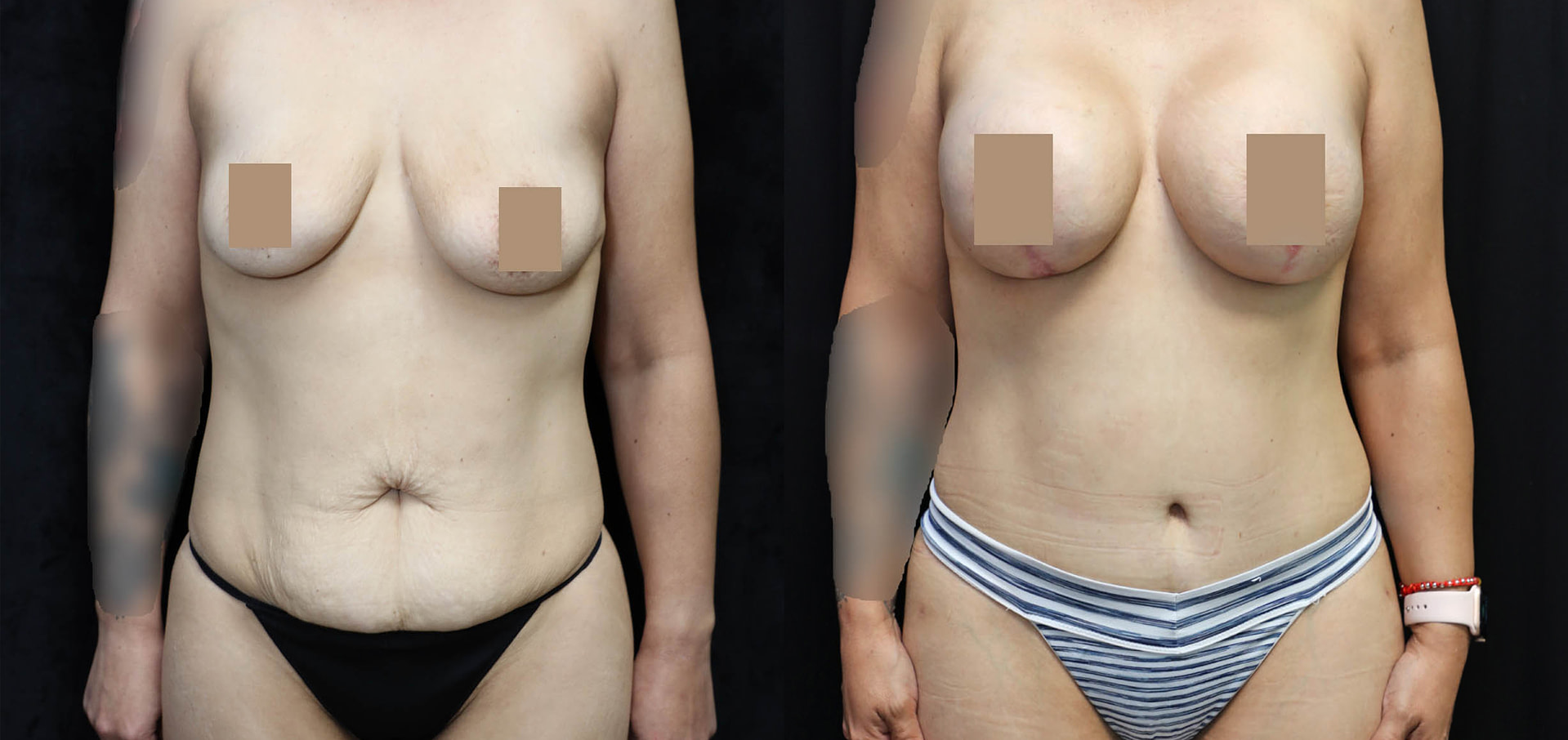 Mommy Makeover Before & After Photos
