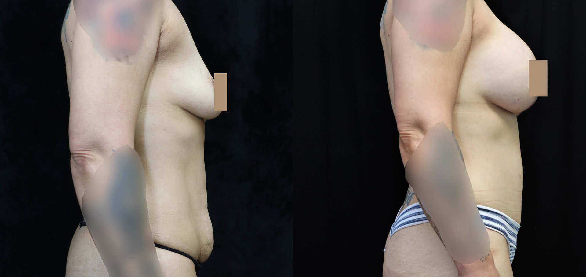 Mommy Makeover Before & After Photos