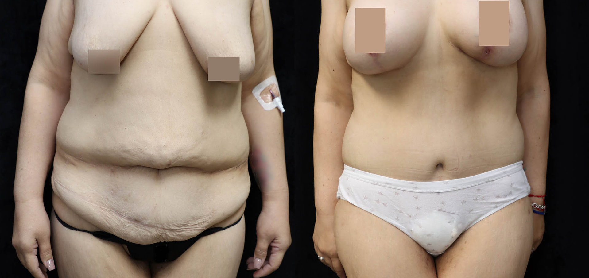 Mommy Makeover Before & After Photos