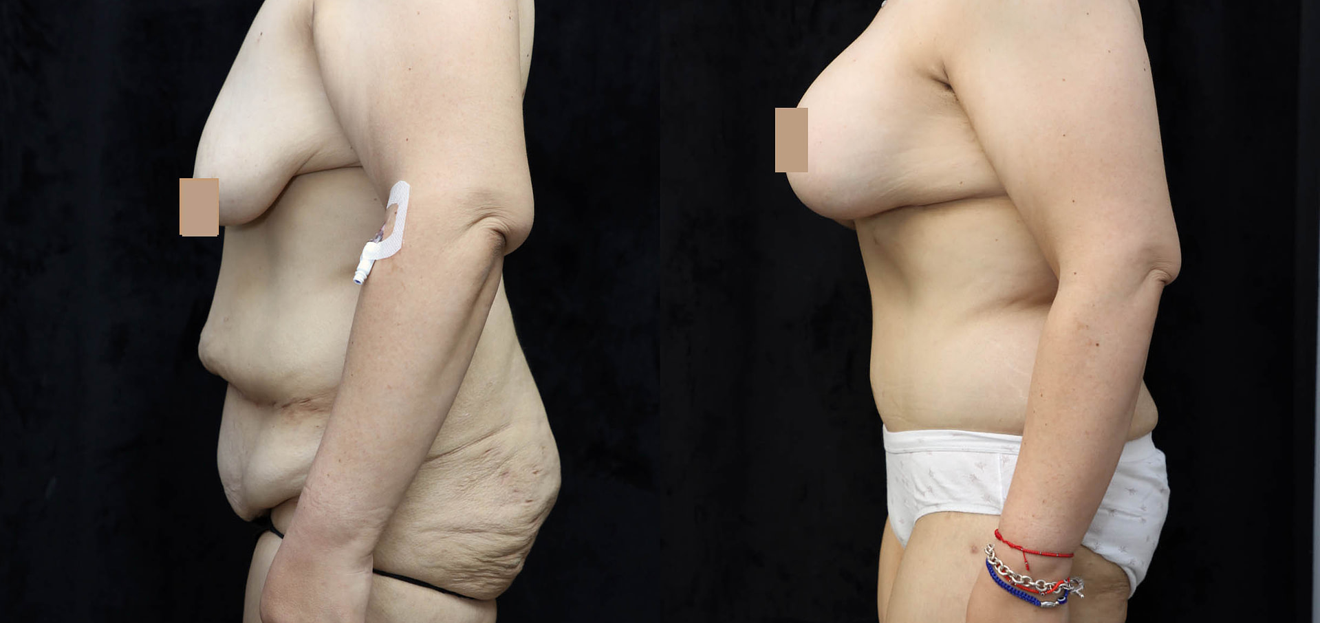 Mommy Makeover Before & After Photos