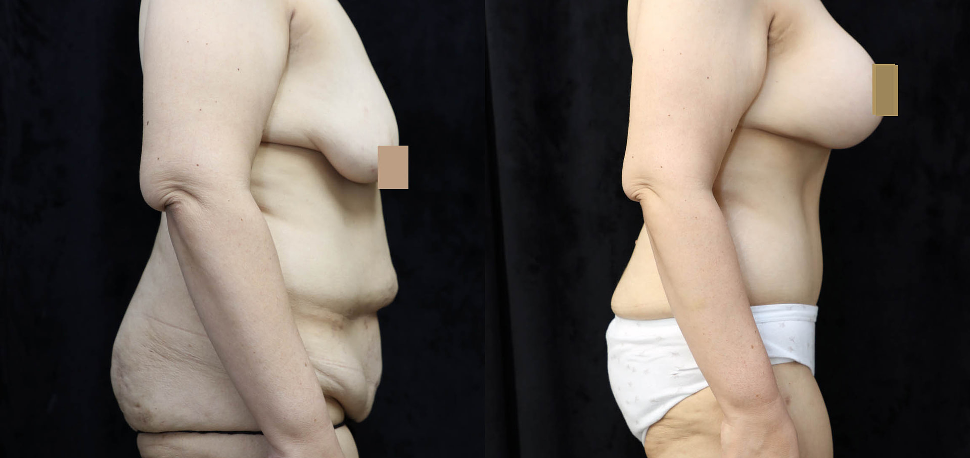 Mommy Makeover Before & After Photos