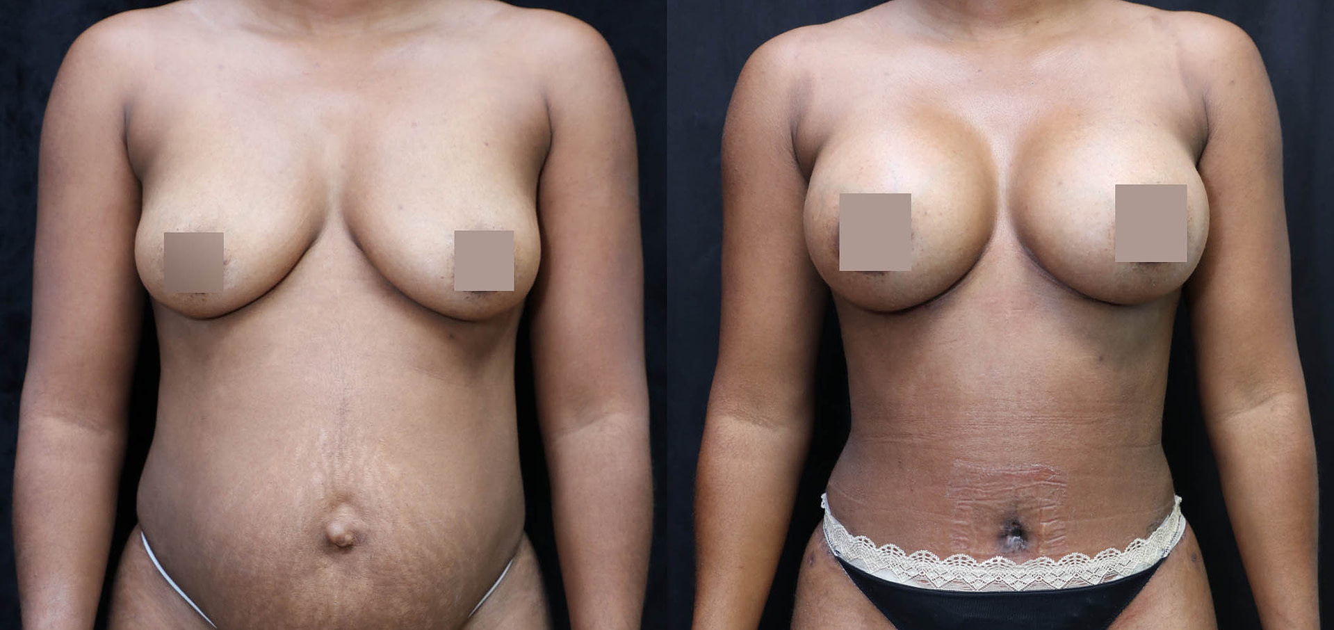 Mommy Makeover Before & After Photos