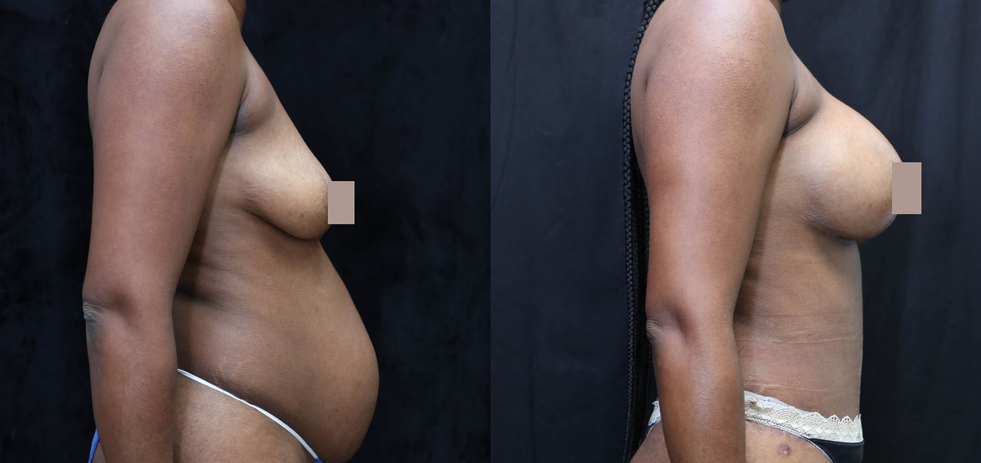 Mommy Makeover Before & After Photos