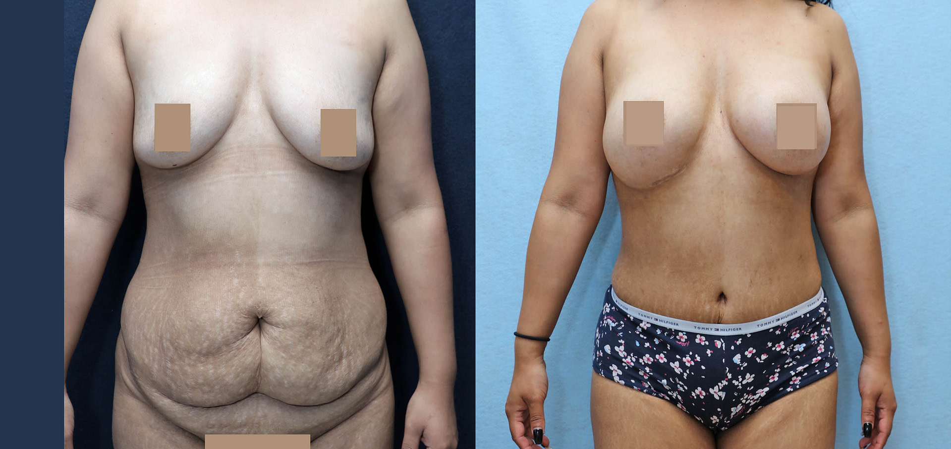 Mommy Makeover Before & After Photos