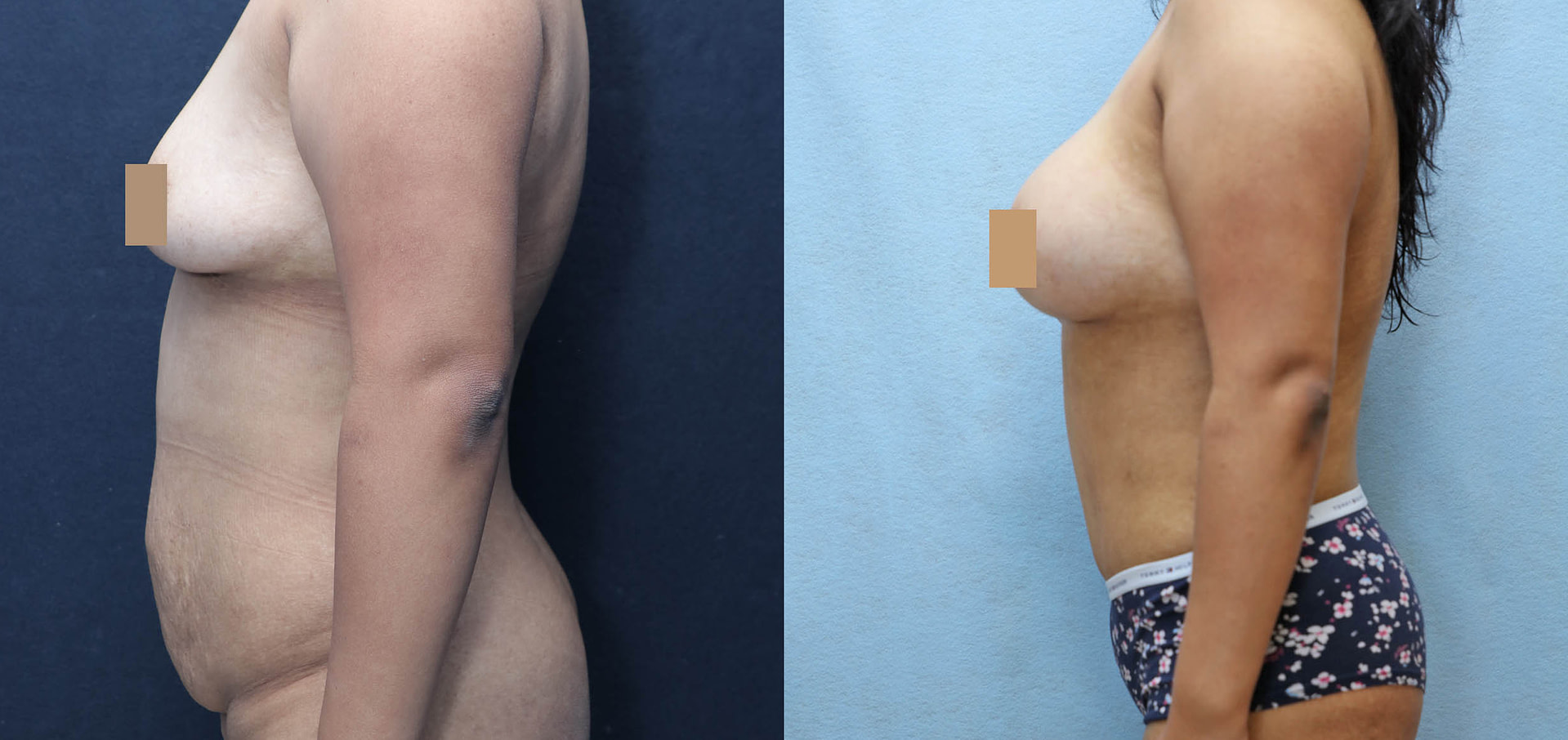 Mommy Makeover Before & After Photos