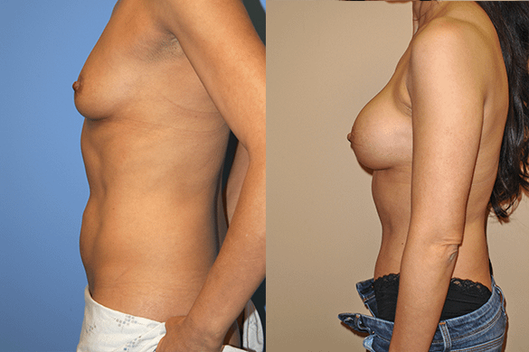 mommy makeover Before & After Photos
