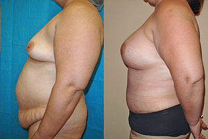 mommy makeover Before & After Photos