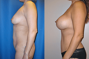 Mommy Makeover Before & After Photos Left