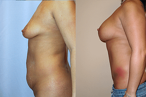 Mommy Makeover Before & After Photos Left