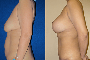 Mommy Makeover Before & After Photos Left