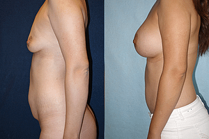 mommy makeover Before & After Photos