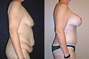 Mommy Makeover right before and after photos