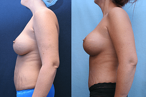 Mommy Makeover Before & After Photos Left Side
