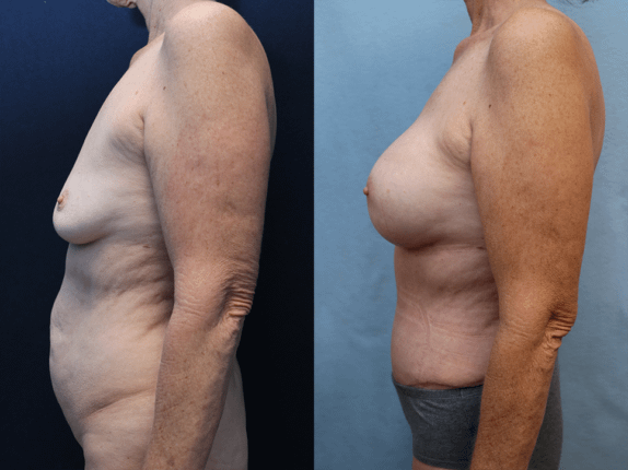 Mommy Makeover Before & After Photos Left Side