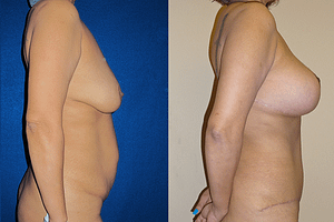 Mommy Makeover Before & After Photos Right