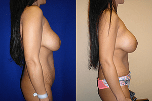 Mommy Makeover Before & After Photos Right