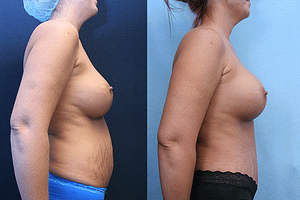 Mommy Makeover Before & After Photos Right Side