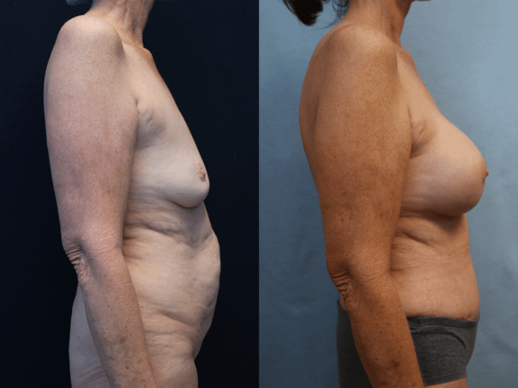 Mommy Makeover Before & After PhotosBefore & After Photos Right Side