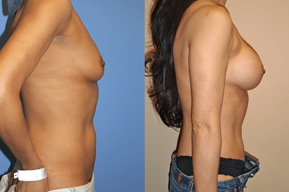 mommy makeover Before & After Photos