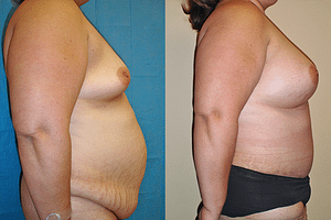 mommy makeover Before & After Photos
