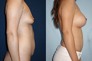 mommy makeover Before & After Photos