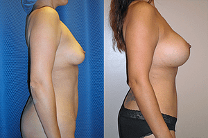 Mommy Makeover Before & After Photos Right