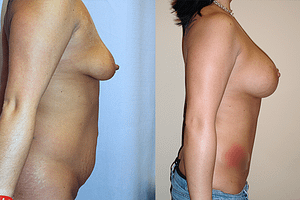 Mommy Makeover Before & After Photos Right