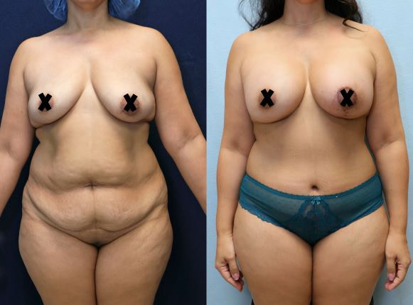 front mommy makeover before and after