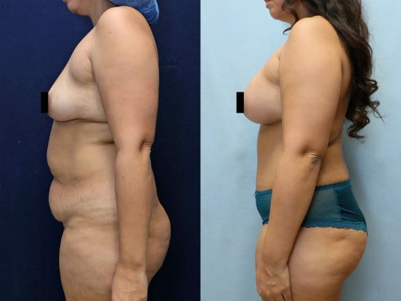 left side before and after mommy makeover