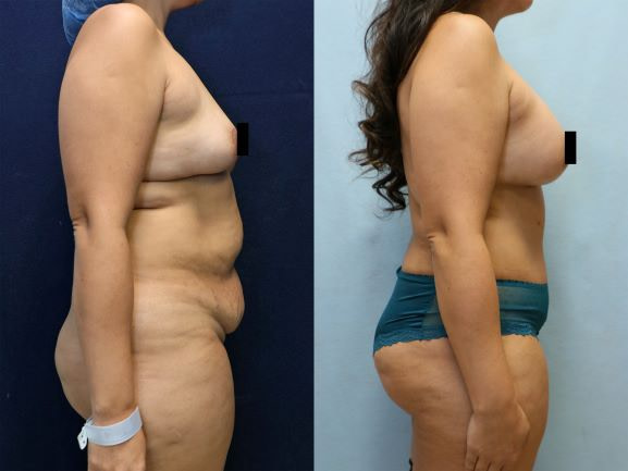 right side before and after mommy makeover