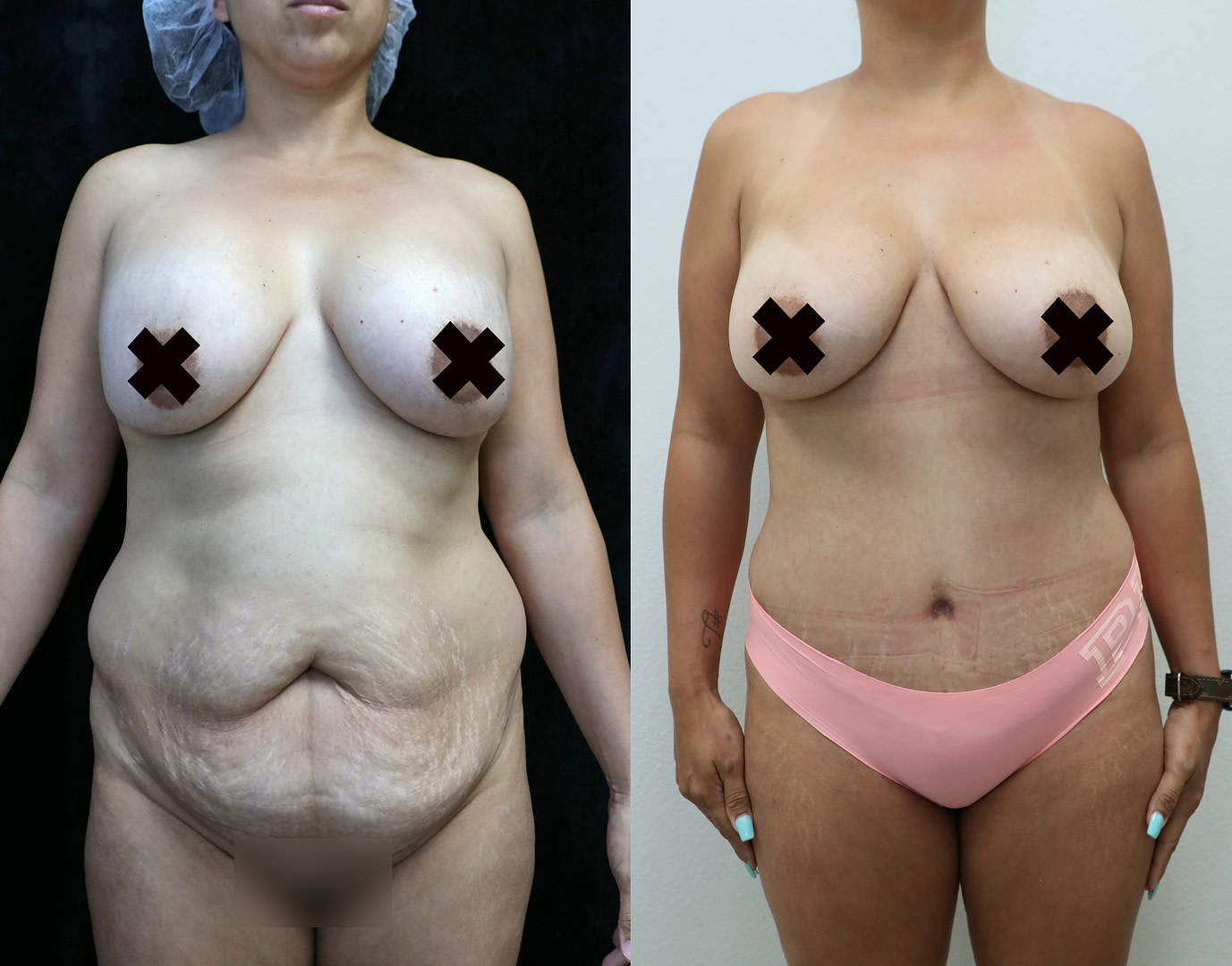 Mommy Makeover