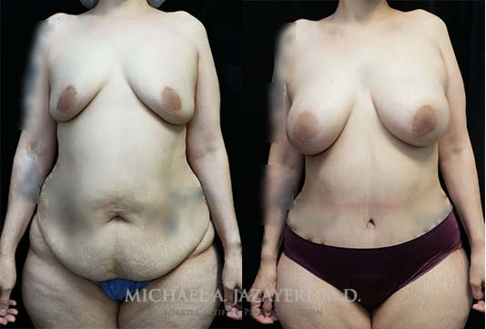 mommy makeover before and after results front