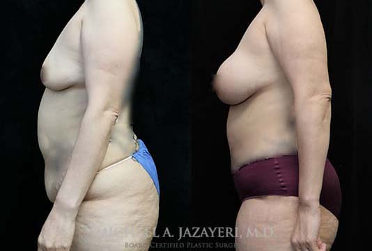 mommy makeover before and after results left