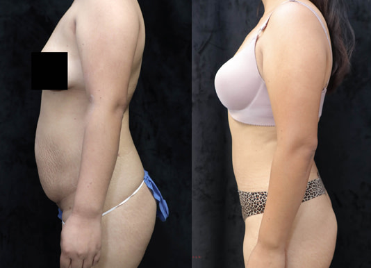 Mommy Makeover Before & After Photos