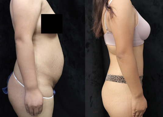 Mommy Makeover Before & After Photos