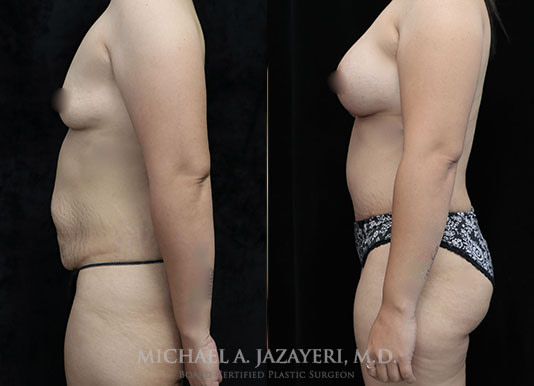 mommy makeover orange county before and after left
