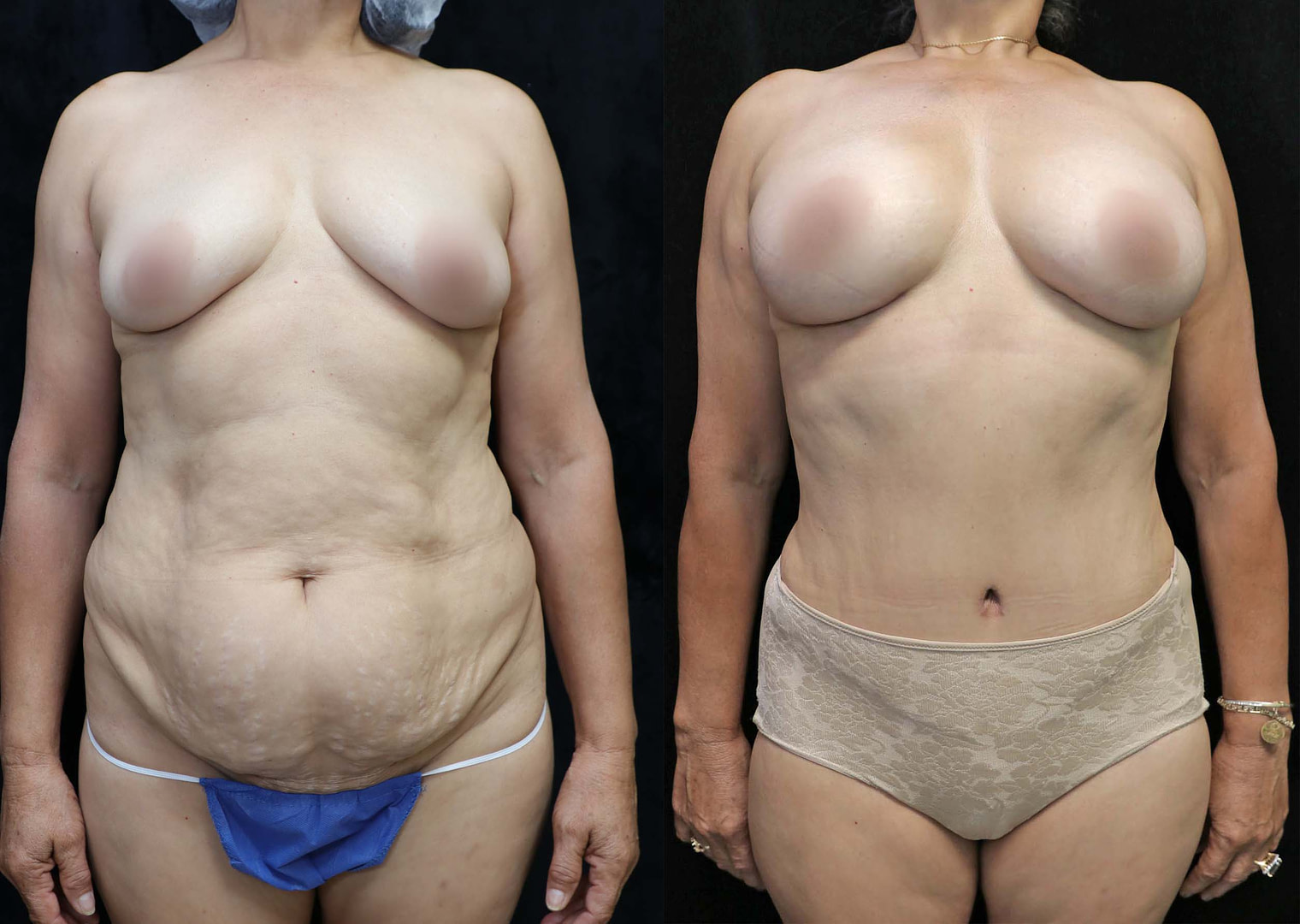 mommy makeover surgery before and after