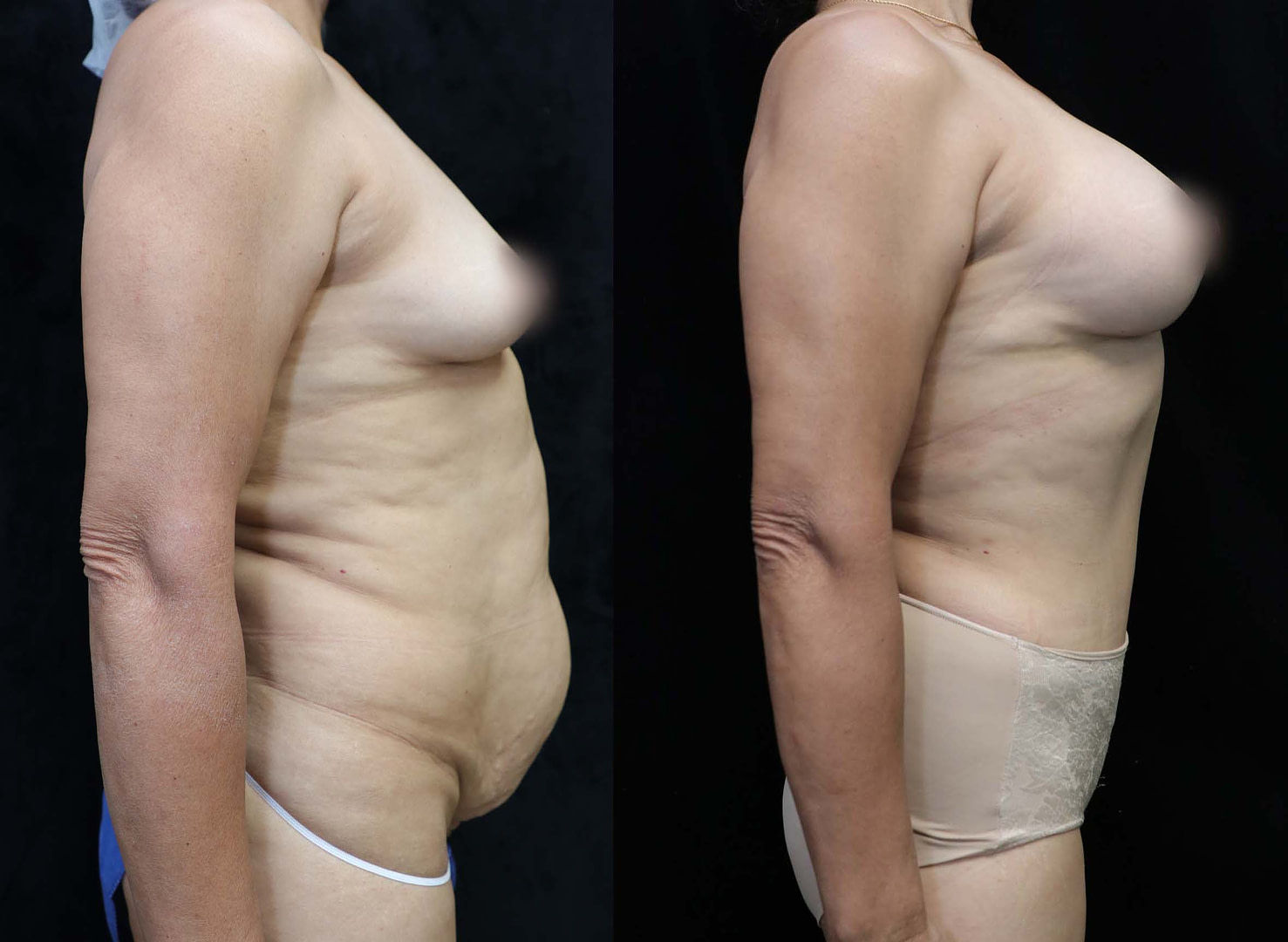 mommy makeover before and after right photos