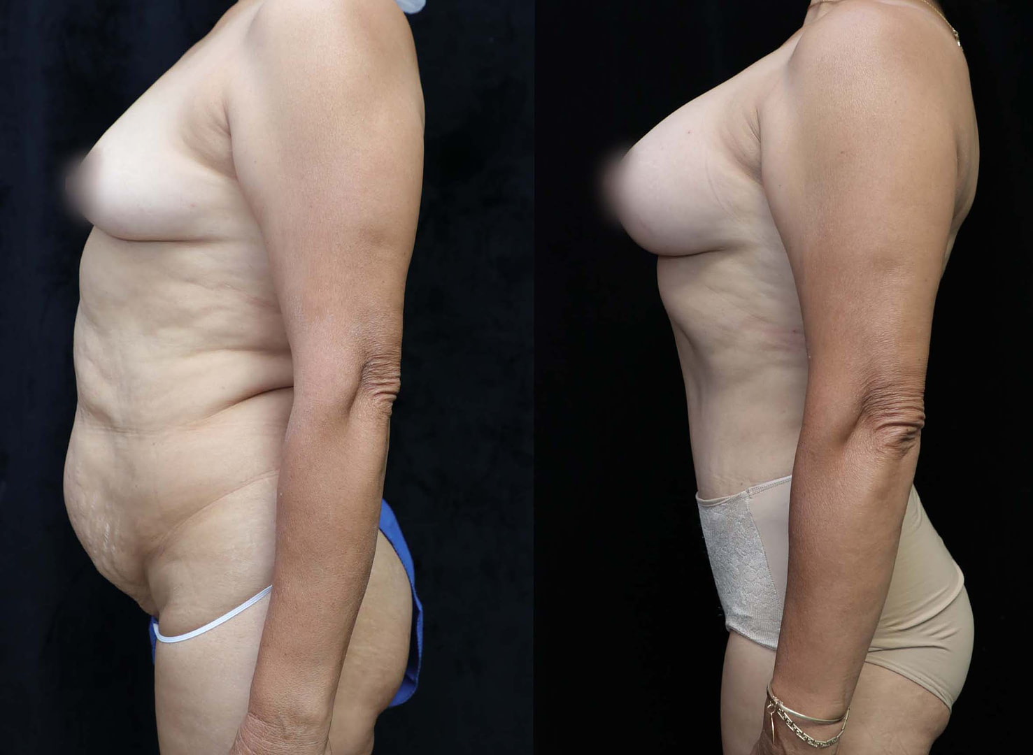 mommy makeover surgery results left side